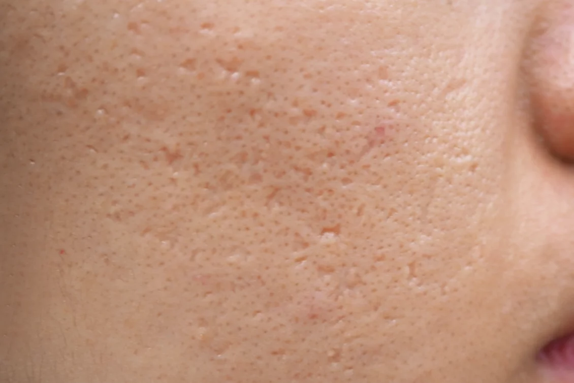 Acne scars treatment Berlin