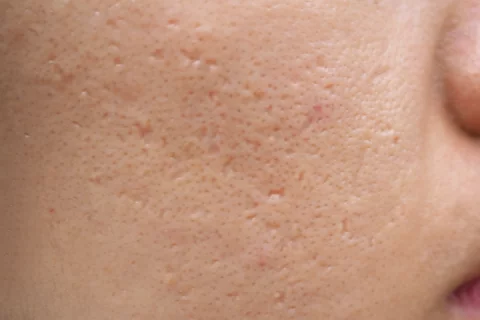 Acne scars treatment Berlin