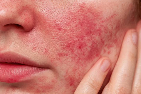 Rosacea treatment Berlin